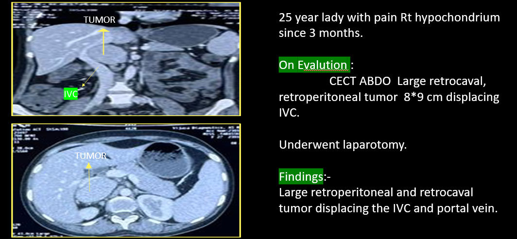 RETROPERITONEAL RETRO CAVAL TUMOR